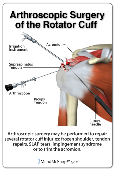 rotator cuff injury rehabilitation