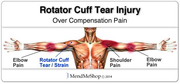 right arm rotator cuff pain