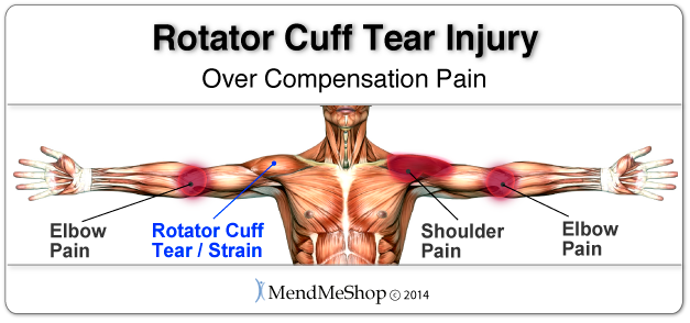 symptoms of rotator cuff damage