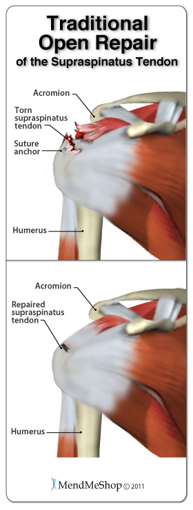 torn rotator cuff surgery recovery