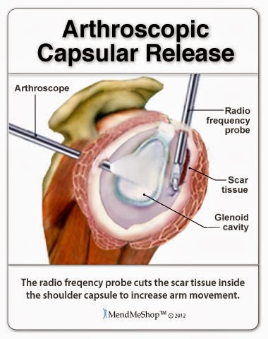 Arthroscopic Capsular Release Shoulder Capsule