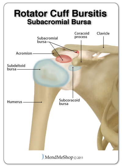 bursa removal shoulder