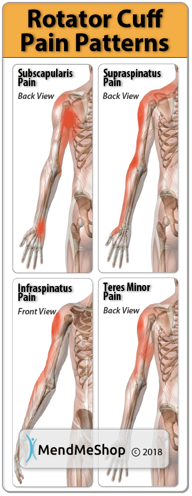 Pain patterns associated with rotator cuff tendon injury vary depending on the tendon. Generally the pain can be deep within your shoulder and radiate down your arm, right to your hand.