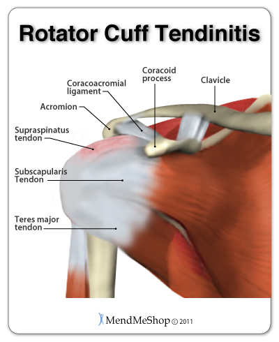 Rotator cuff tendinitis is often caused by wear and tear within the shoulder or from an acute injury such as a fall.