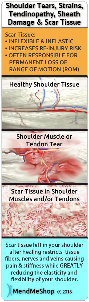 Rotator cuff surgery can heal with difficulties because of scar tissue