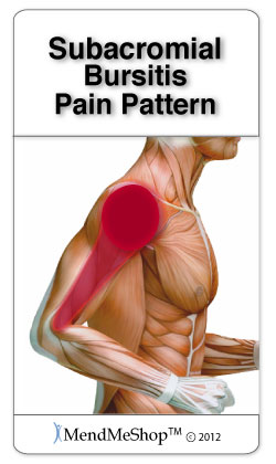 Pain pattern subacromial bursitis