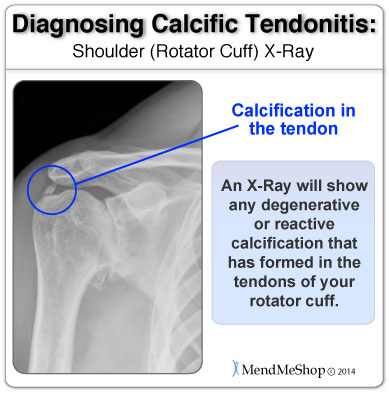 Calcific tendonitis pain will focus on the front and side of the shoulder then radiate down the upper arm.